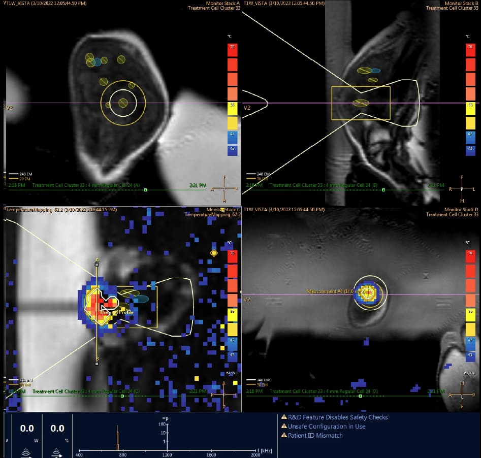 2.	An MRI image displaying thermal mapping indicating treated vs. untreated cells