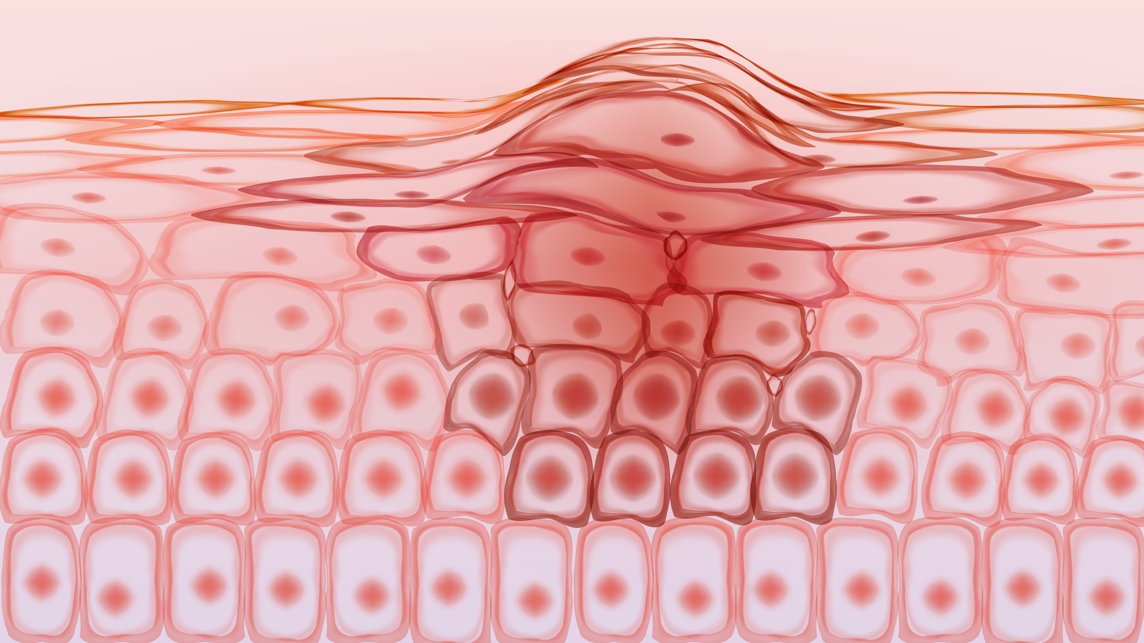 Skin tissue cancerous cells, melanoma stock illustration